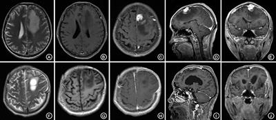 Diagnosis and Treatment of Cerebral Syphilitic Gumma: A Report of Three Cases